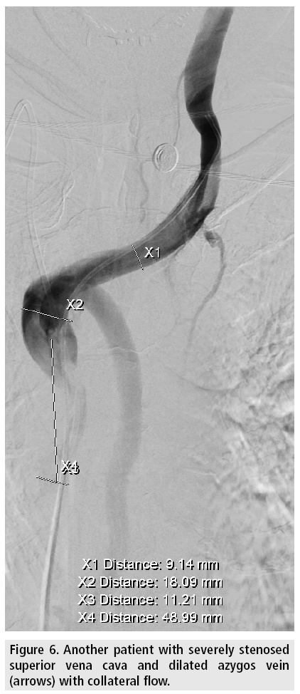 imaging-in-medicine-stenosed