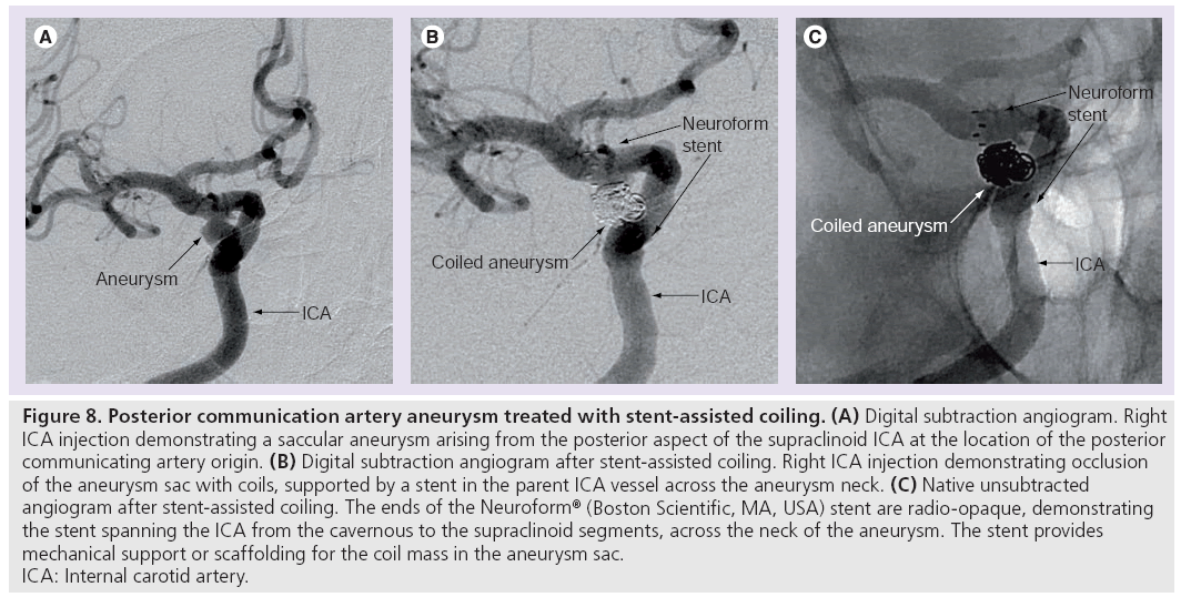 imaging-in-medicine-stent-assisted