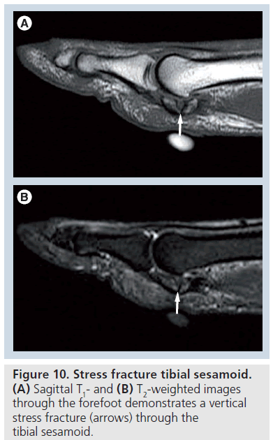 imaging-in-medicine-stress-fracture