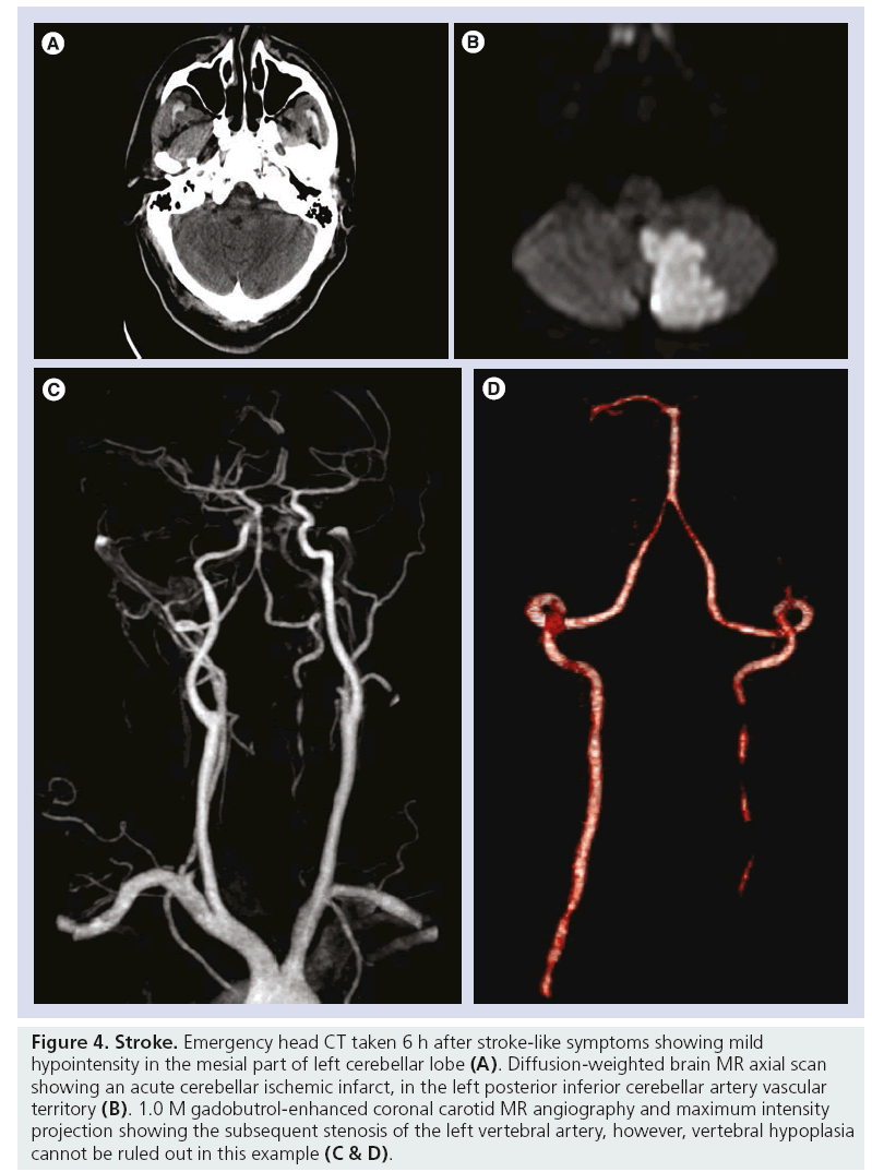 imaging-in-medicine-stroke-like