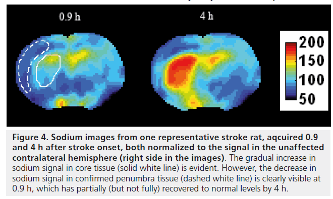 imaging-in-medicine-stroke-onset