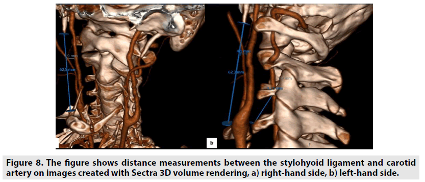imaging-in-medicine-stylohyoid-ligament