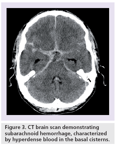 Strokes are caused by