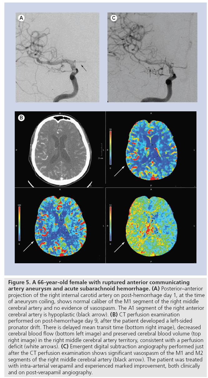 imaging-in-medicine-subarachnoid-hemorrhage