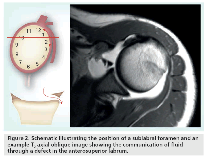 imaging-in-medicine-sublabral-foramen