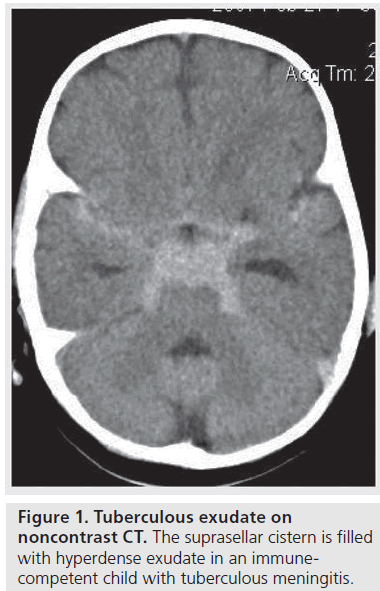 imaging-in-medicine-suprasellar-cistern