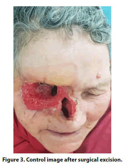 imaging-in-medicine-surgical-excision