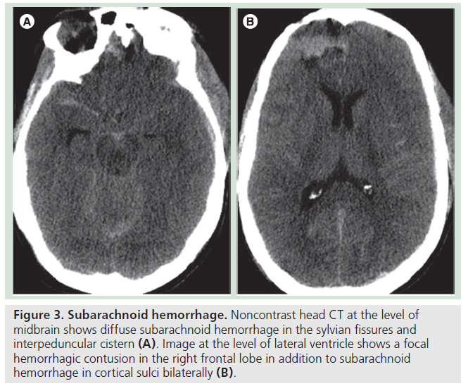 imaging-in-medicine-sylvian-fissures