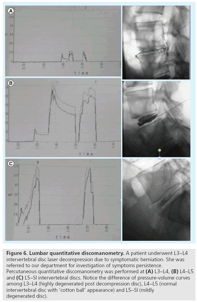 imaging-in-medicine-symptomatic-herniation