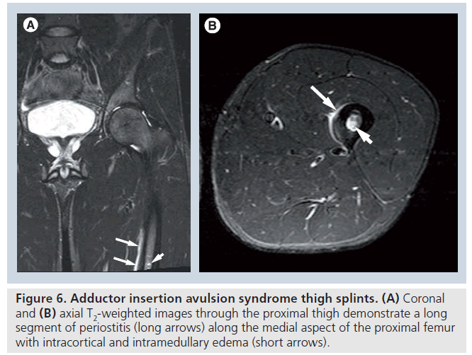imaging-in-medicine-syndrome-splints
