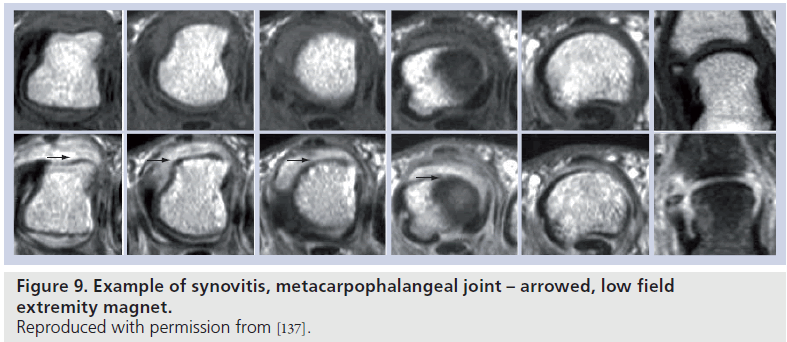 imaging-in-medicine-synovitis-metacarpophalangeal