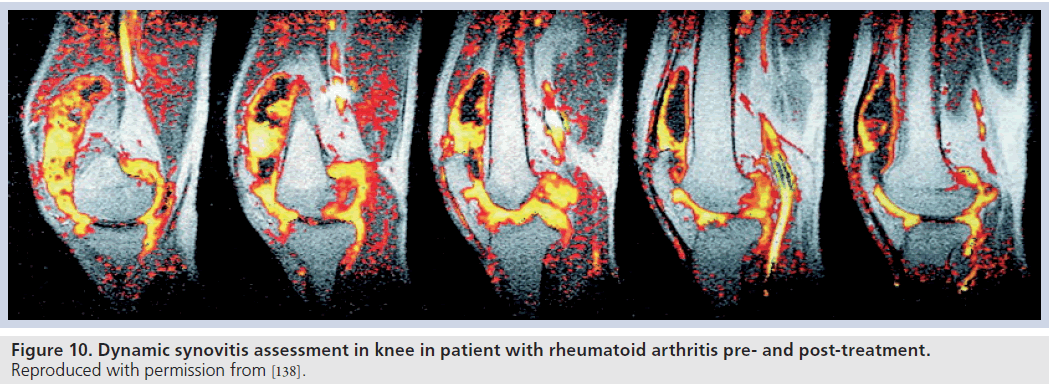 imaging-in-medicine-synovitis-post-treatment