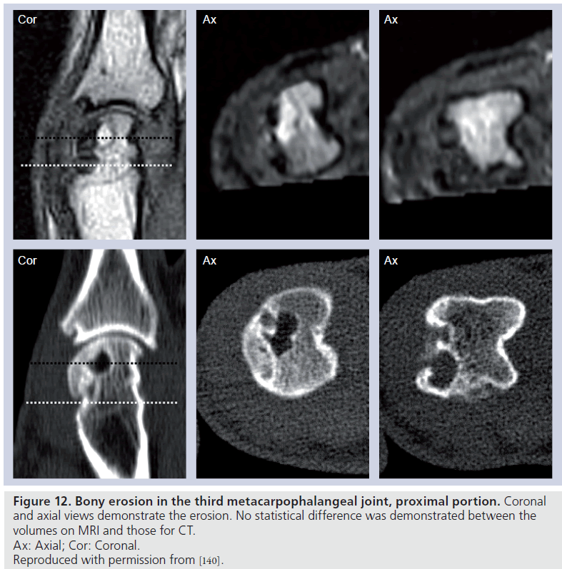 imaging-in-medicine-synovitis-third-metacarpophalangeal