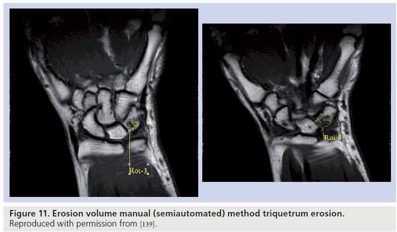 imaging-in-medicine-synovitis-triquetrum-erosion