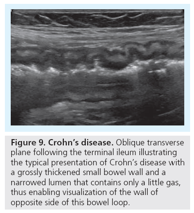 imaging-in-medicine-terminal-ileum