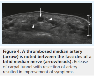 imaging-in-medicine-thrombosed-median