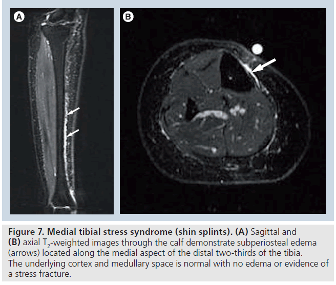 imaging-in-medicine-tibial-stress