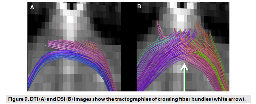 imaging-in-medicine-tractographies-crossing