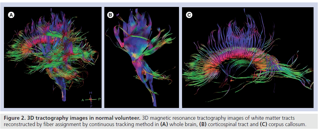 imaging-in-medicine-tractography-images