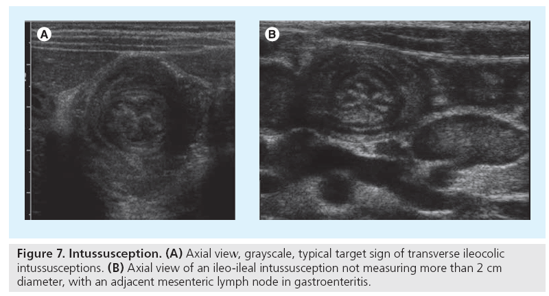 imaging-in-medicine-transverse-ileocolic