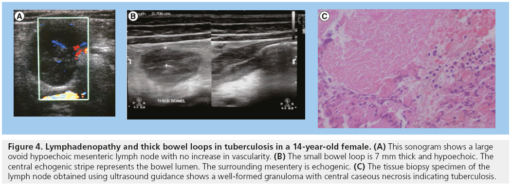 imaging-in-medicine-tuberculosis