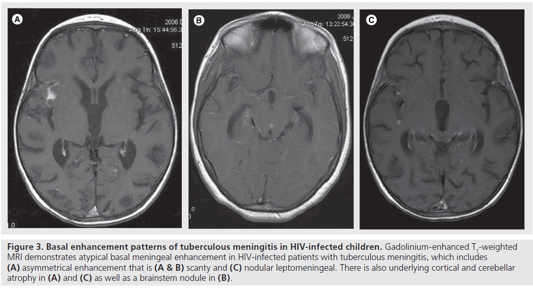 imaging-in-medicine-tuberculous-meningitis