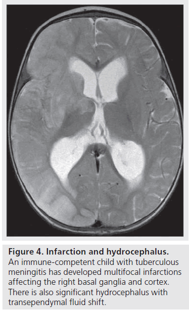 imaging-in-medicine-tuberculous-meningitis