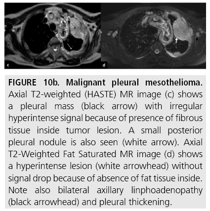 is mesothelioma and lung cancer the same