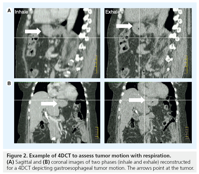imaging-in-medicine-tumor-motion