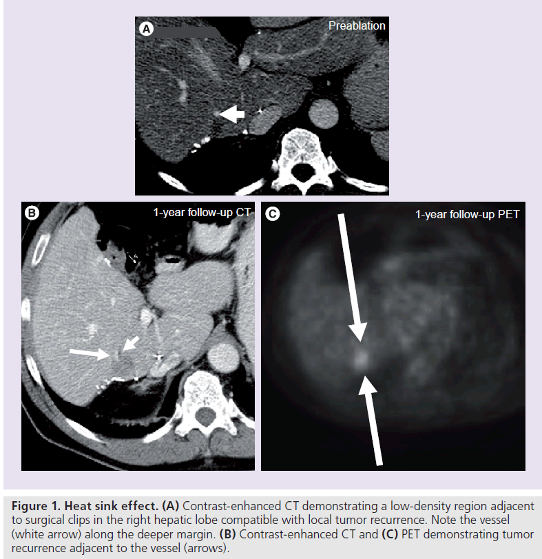 imaging-in-medicine-tumor-recurrence