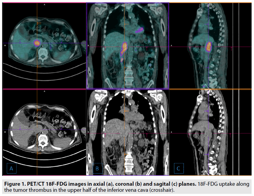 imaging-in-medicine-tumor-thrombus