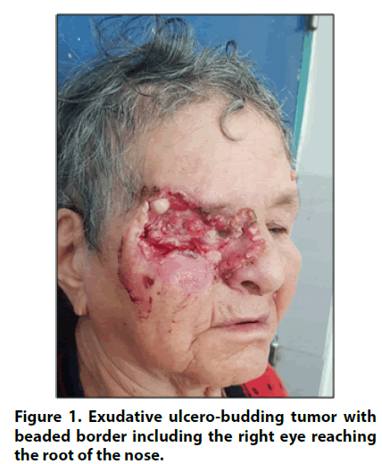 imaging-in-medicine-ulcero-budding