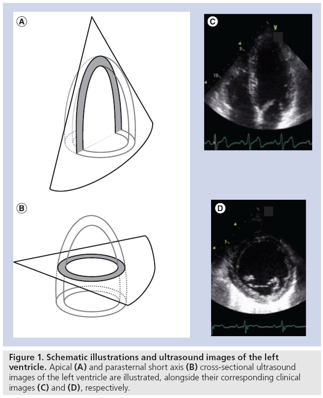 Myocardial strain to detect subtle left ventricular systolic