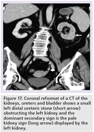 imaging-in-medicine-ureteric-stone