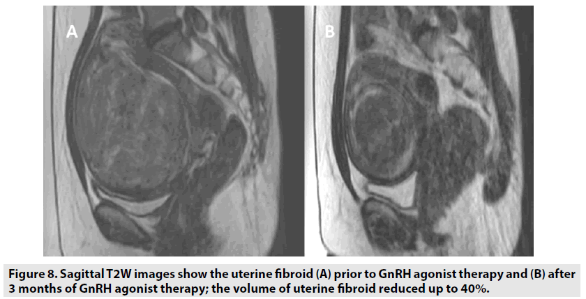 imaging-in-medicine-uterine-fibroid