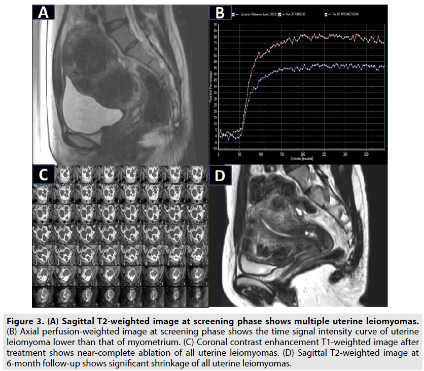 imaging-in-medicine-uterine-leiomyomas