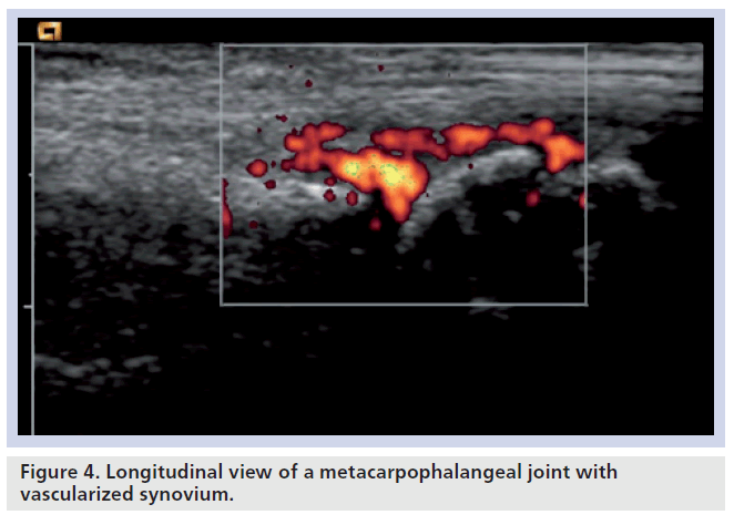 imaging-in-medicine-vascularized-synovium