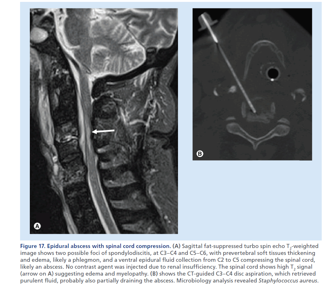 imaging-in-medicine-ventral–epidural