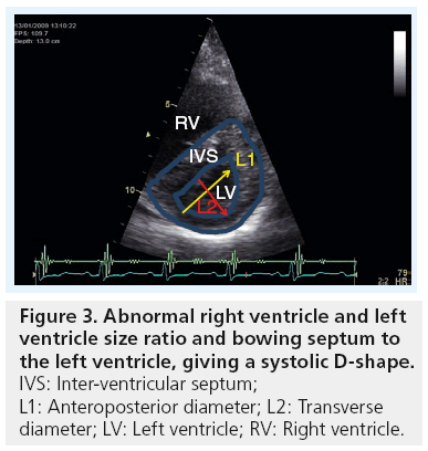 imaging-in-medicine-ventricle-size