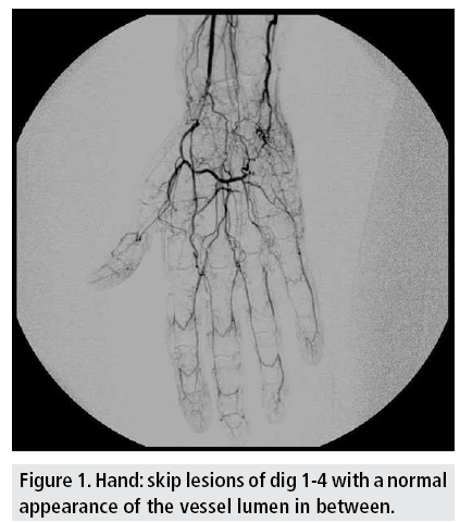 imaging-in-medicine-vessel-lumen