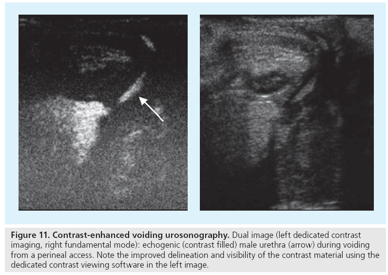 imaging-in-medicine-voiding-urosonography