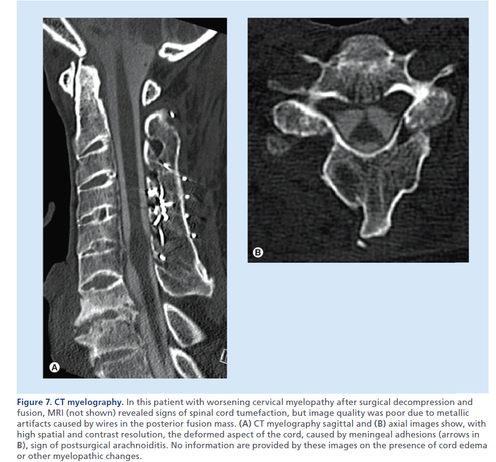 imaging-in-medicine-worsening-cervical