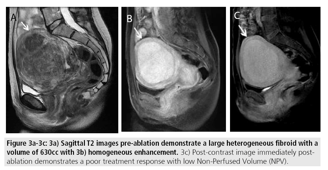 imaging-medicine-Sagittal-t2-images-pre-ablation