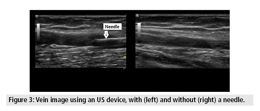 imaging-medicine-Vein-image-using-US-device