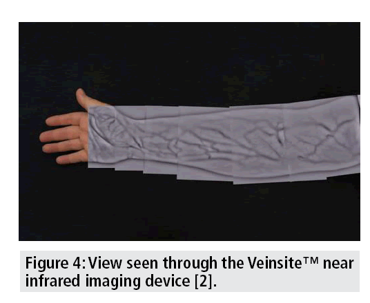 imaging-medicine-Vein-through-the-veinsite