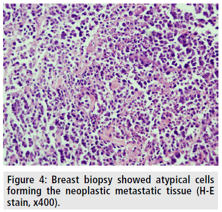 imaging-medicine-breast-biopsy-showed-atypical