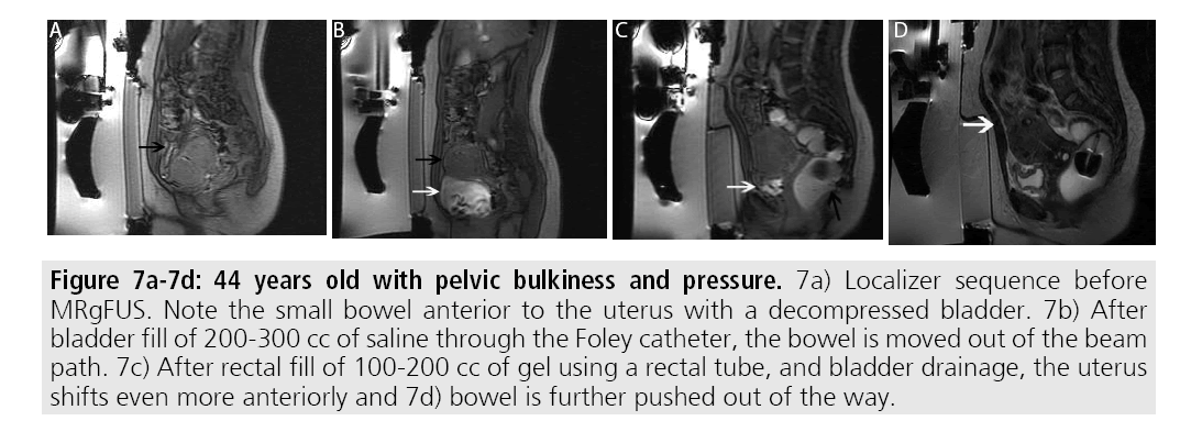 imaging-medicine-pelvic-bulkiness-pressure