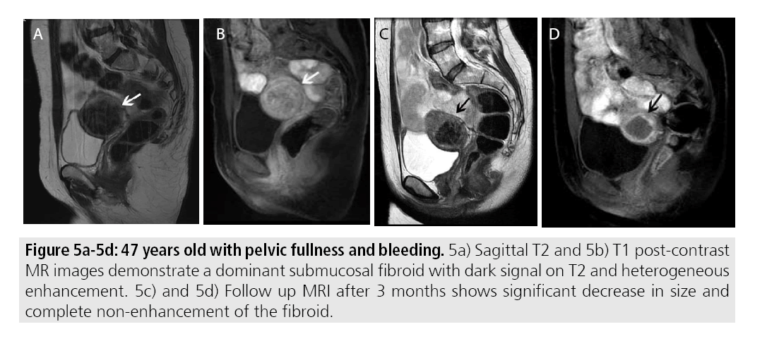 imaging-medicine-pelvic-fullness-and-bleeding