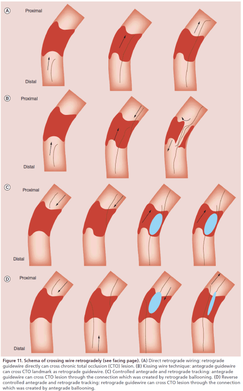 interventional-Direct-wiring