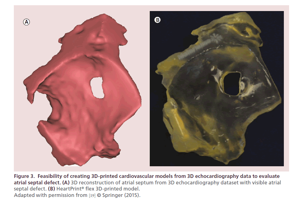 interventional-cardiology-3D-printed-cardiovascular